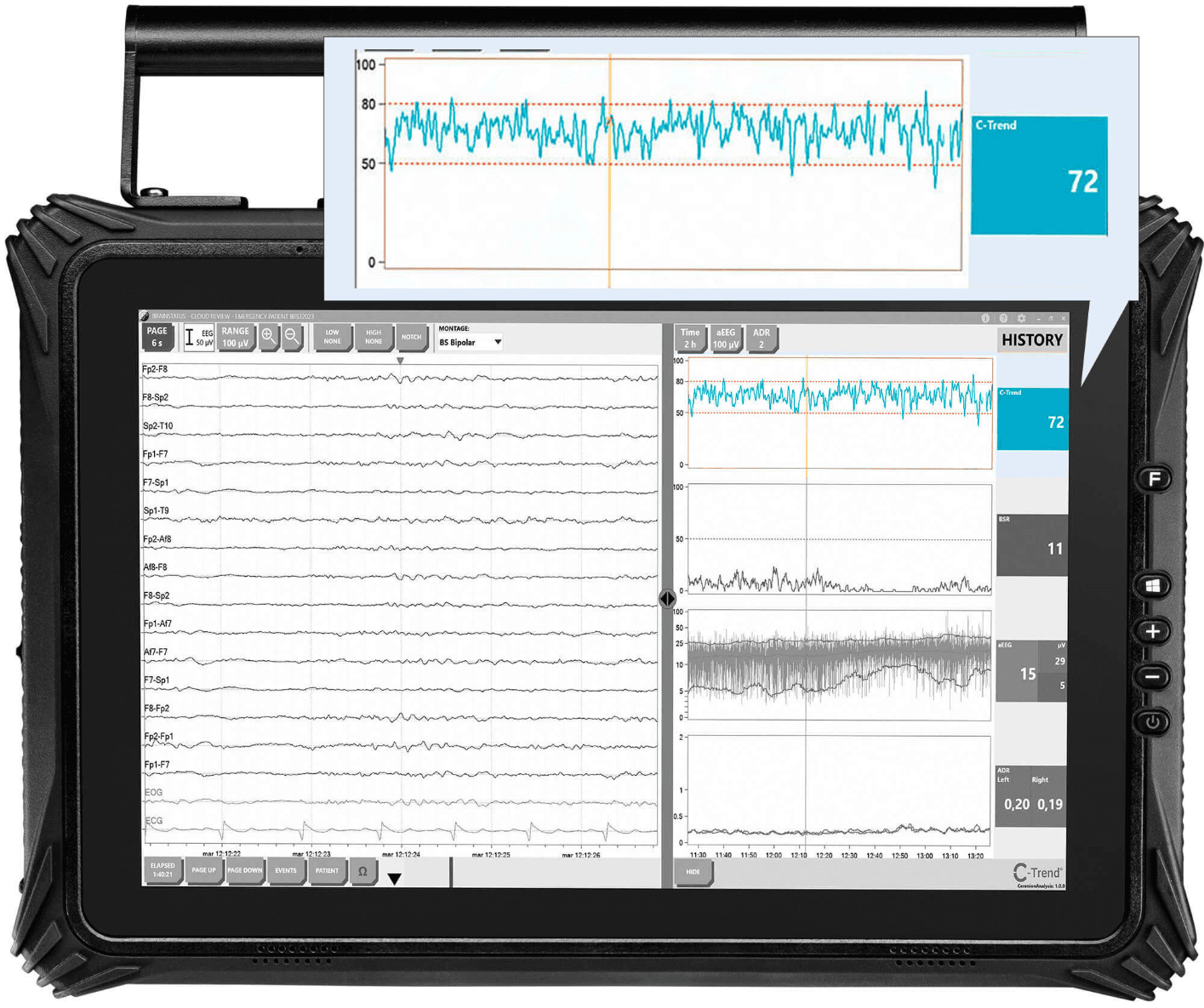 C-Trend in Bittium’s BrainStatus monitor