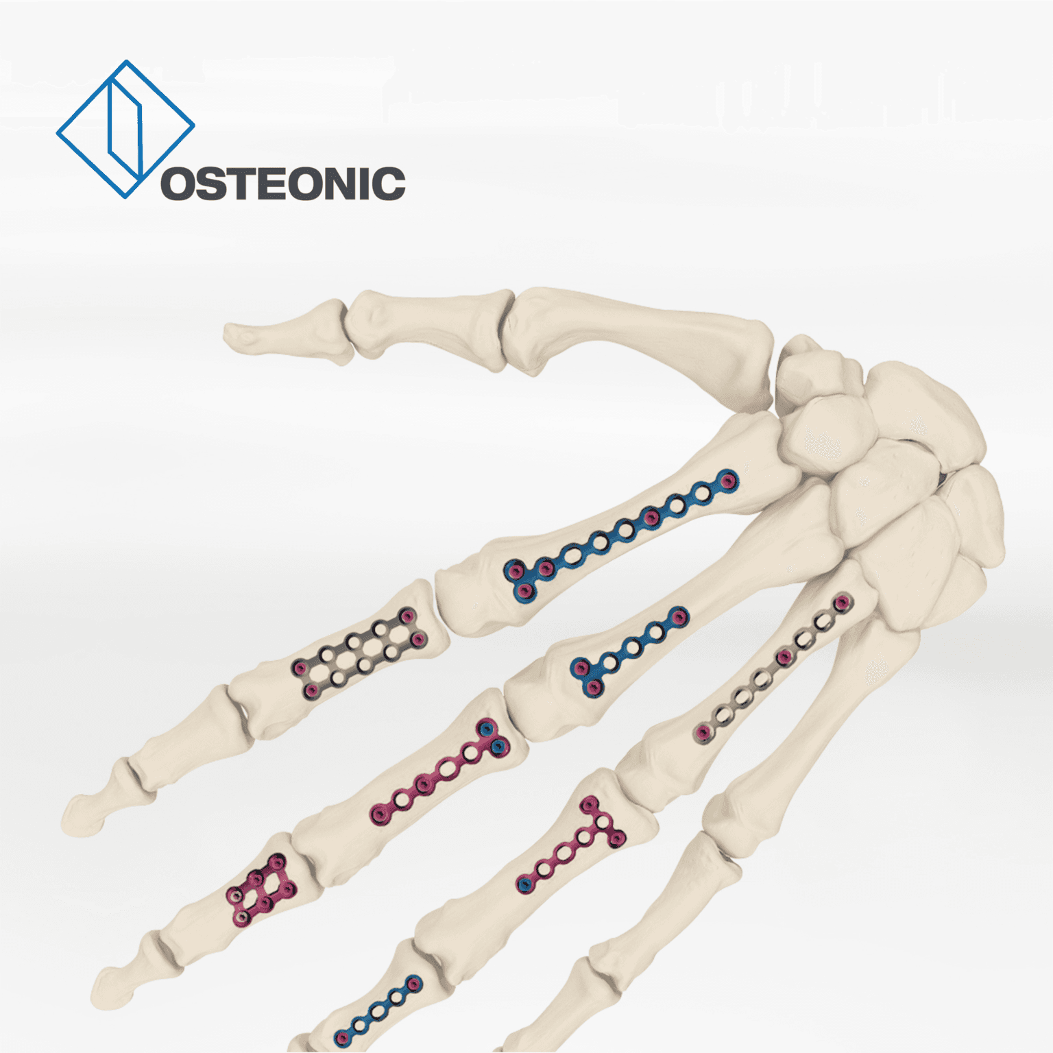 Osteonic hand